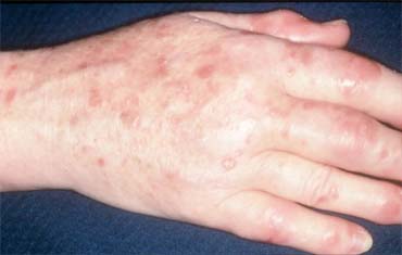 Haematology Test in Gandhinagar
